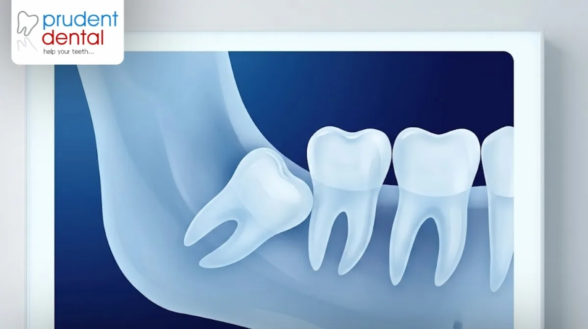 Tooth extraction aftercare: a day-by-day guide
