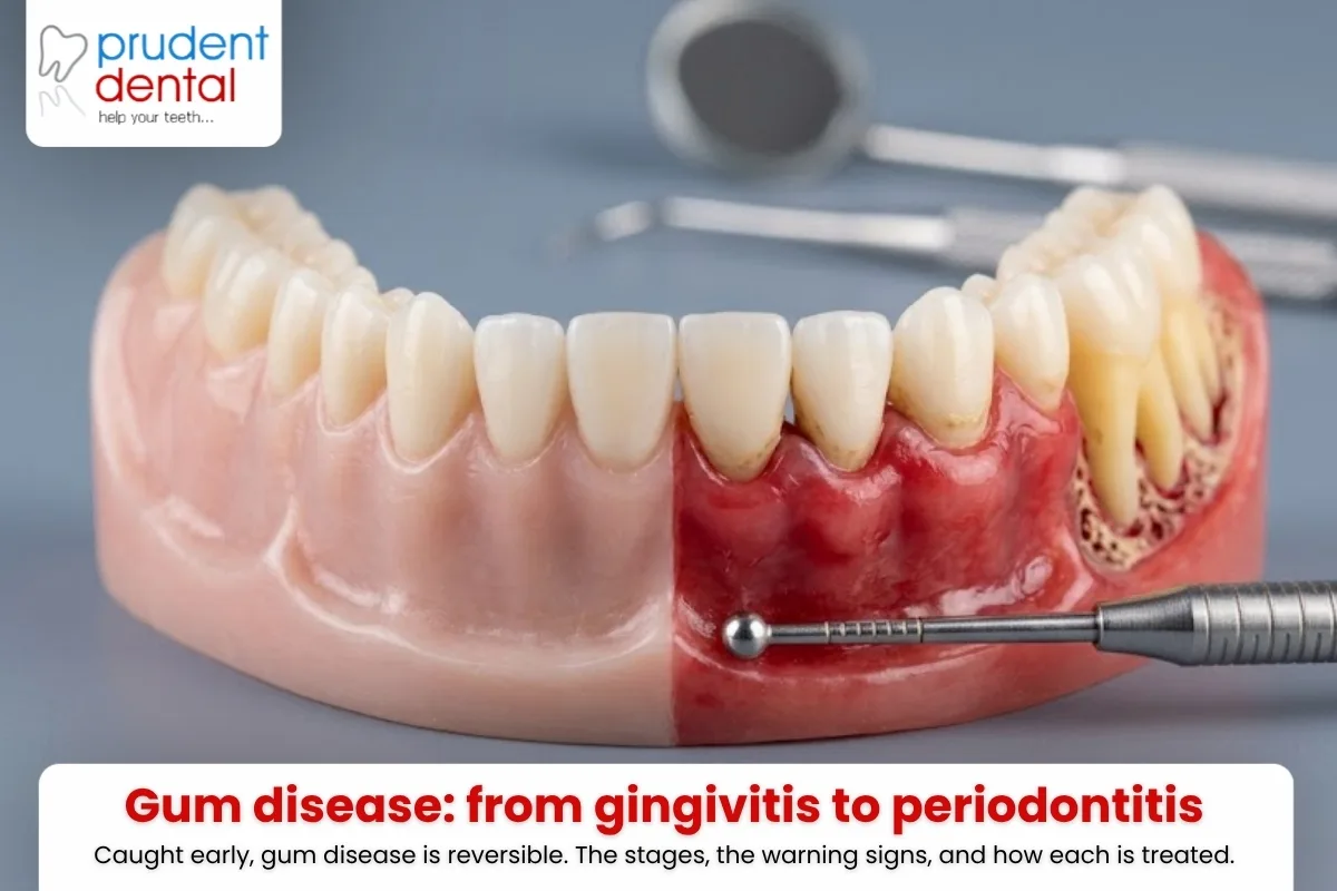 Gum disease: from gingivitis to periodontitis