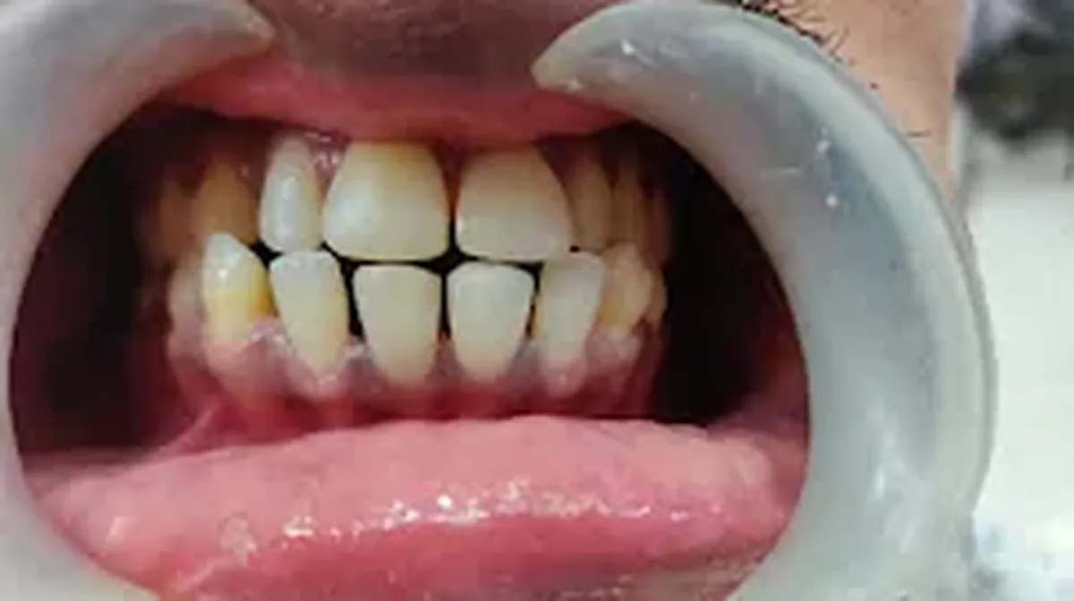 Close-up of a patient's teeth during an orthodontic assessment for invisible aligners in Pune