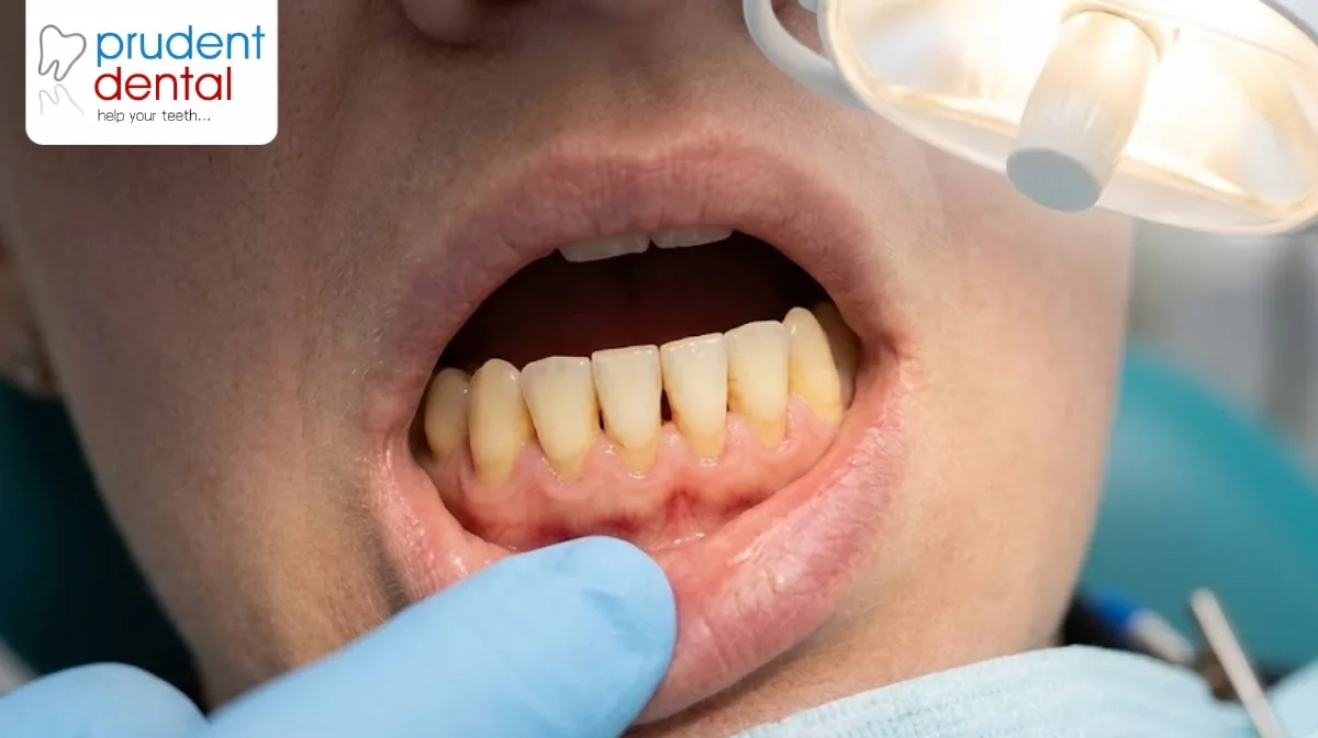 Receding gums: causes, and how to stop it