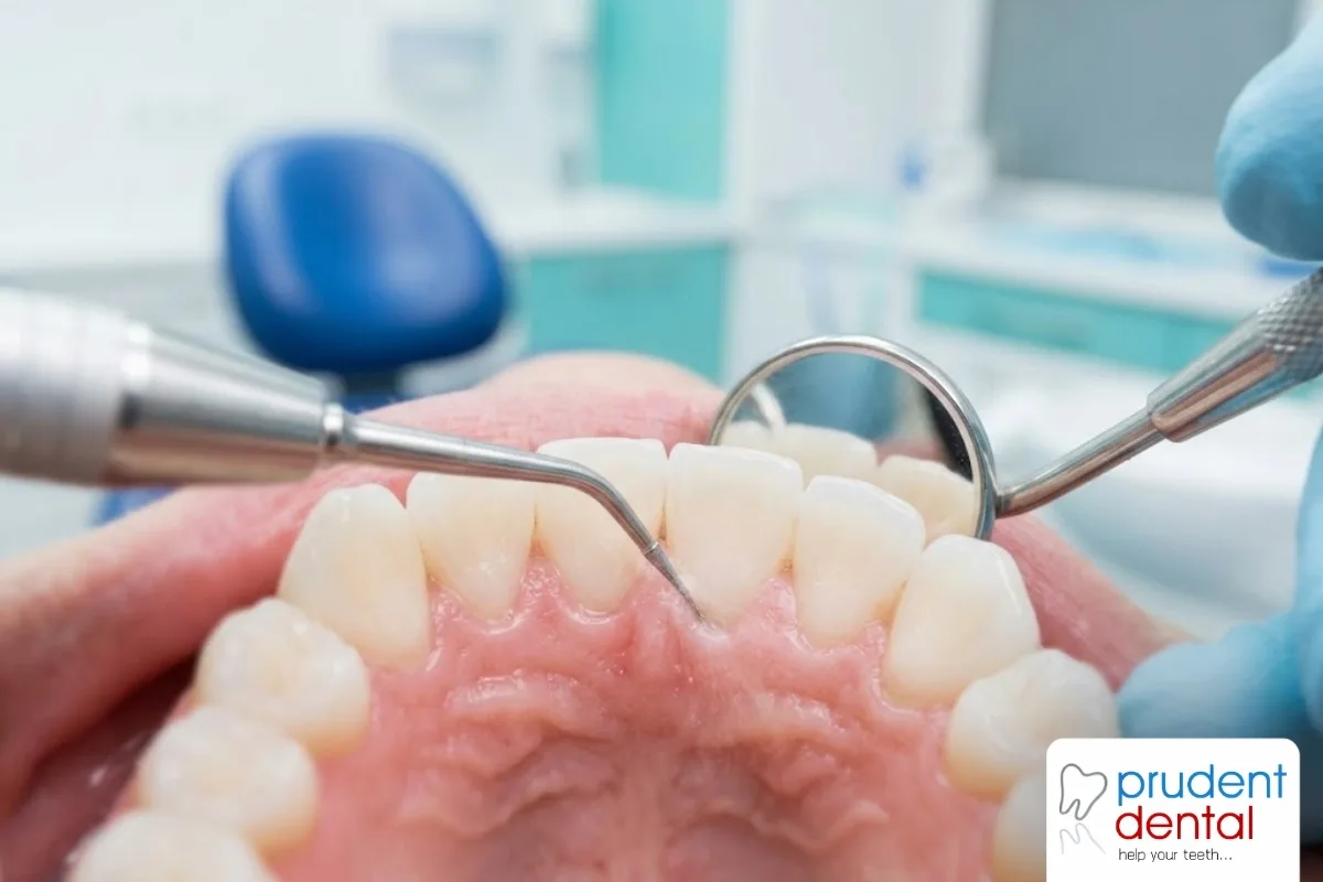 Dentist performing a professional scaling and polishing treatment for a patient in a dental clinic treatment room