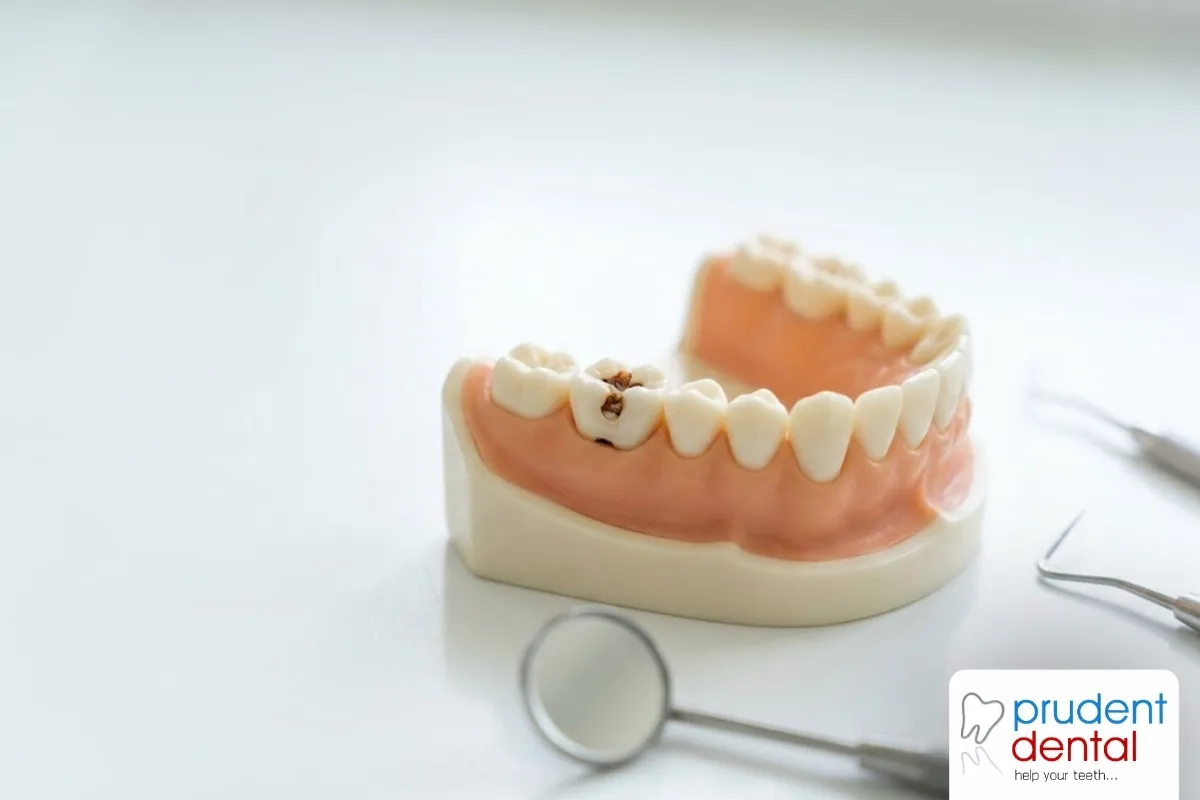 A dentist discussing tooth decay and treatment options with a patient in Viman Nagar, Pune
