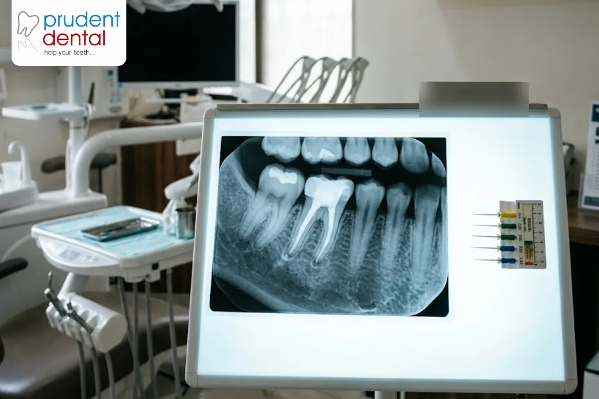 A tooth model showing the canals treated in a root canal, illustrating what affects the cost