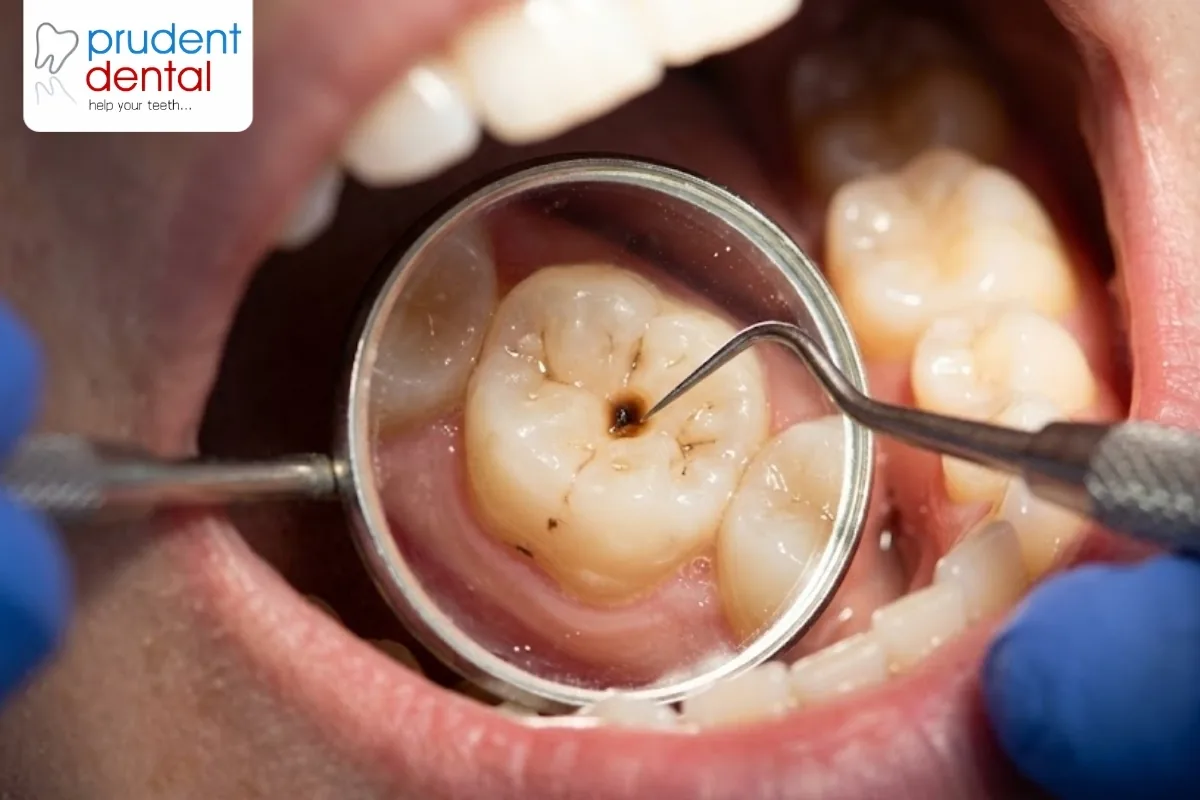 A dentist checking a tooth for early signs of decay during an examination