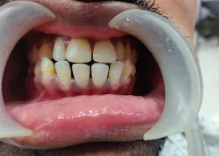 Close-up of a patient’s teeth during an orthodontic assessment