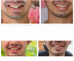 Before and after smile results at Prudent Dental Clinic