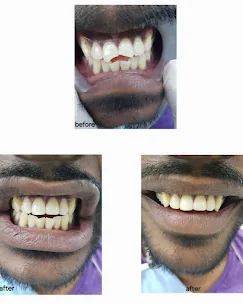 Before and after of a brighter smile at Prudent Dental Clinic